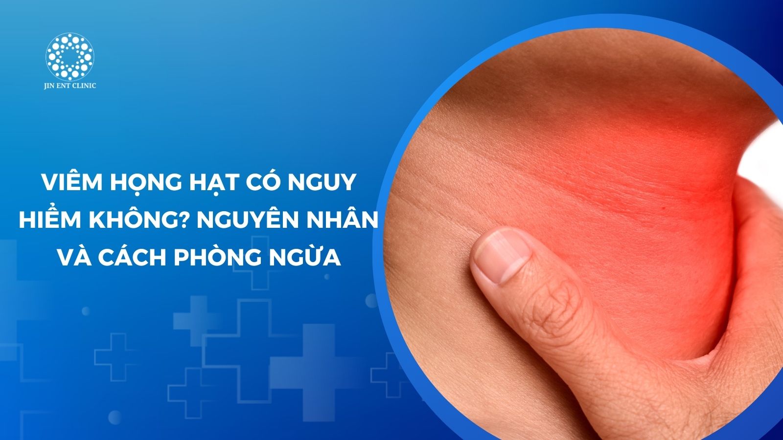Viêm họng hạt thường xuất hiện ở những người tái phát viêm họng nhiều lần
