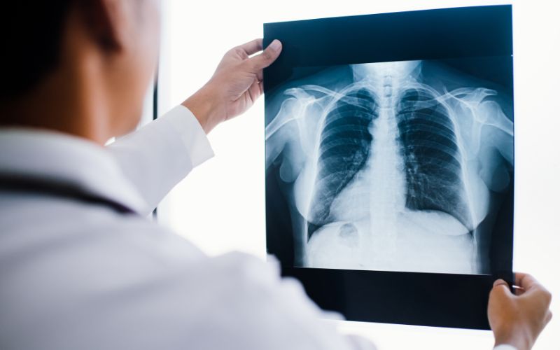Chụp X quang phổi để tìm ra tổn thương phổi và xác định nguyên nhân dẫn đến tình trạng ho nhiều về đêm ở người lớn tuổi